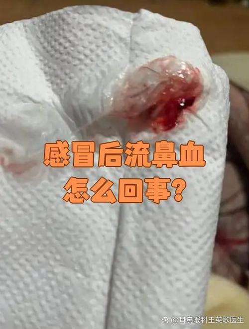 脸发黄流鼻血怎么回事缩略图