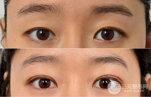 纳米无痕双眼皮和埋线有什么区别缩略图