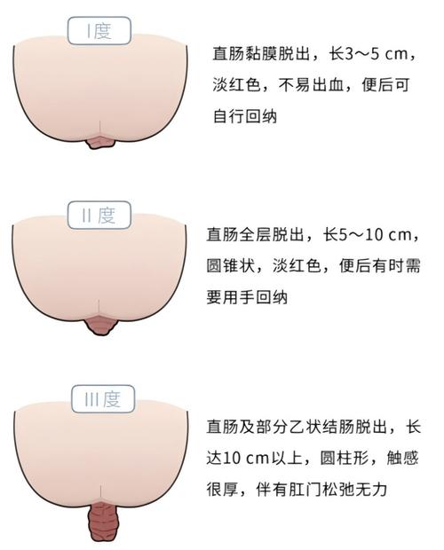肛门外翻会自愈吗缩略图