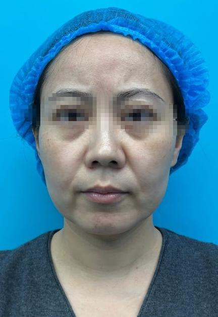 我做了面部筋膜提升术缩略图