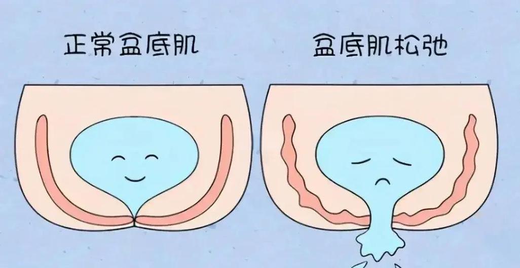 盆底肌紧致的表现图标