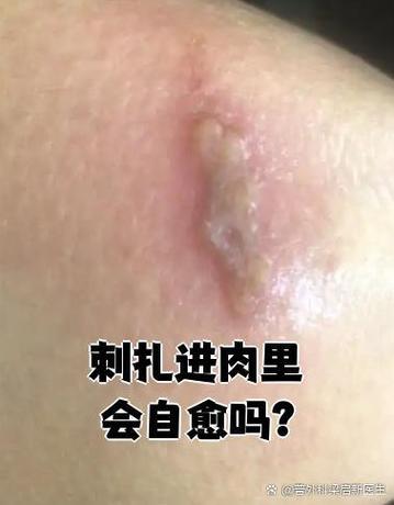 针丢了会不会扎进身体缩略图