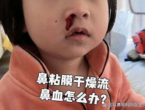 屋子干会流鼻血吗