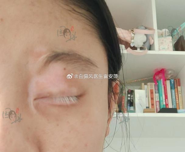 白灵片治疗白癜风效果好吗图标