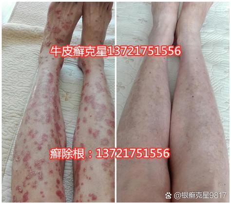 皮肤癣的广告词缩略图
