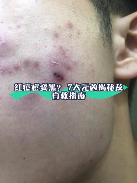 黑痘印怎么去除图标