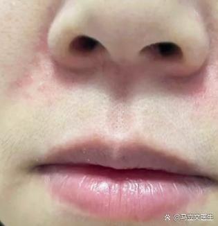 鼻翼两边有白色的皮屑是什么原因