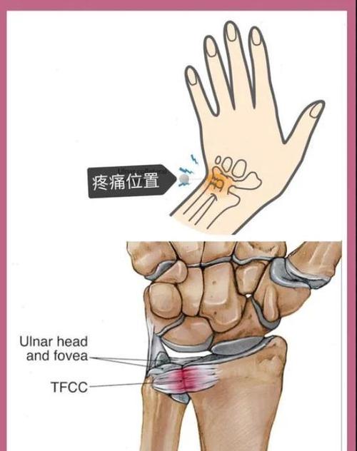 tfcc损伤有什么症状游戏截图