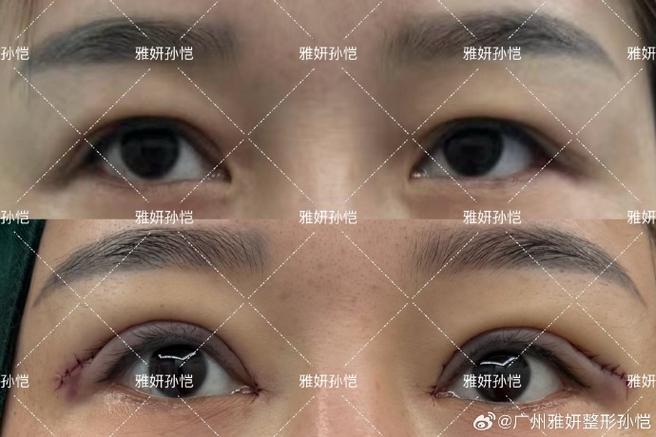 内双突然变成外双好几天了