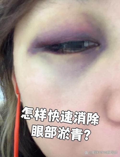 眼睛撞肿了怎么快速消肿淤青缩略图