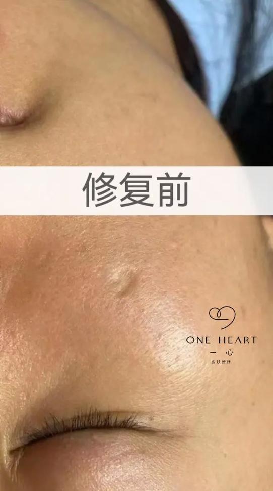 痘坑痘印能恢复到正常皮肤吗