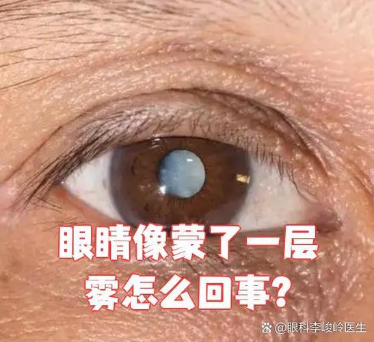 眼睛蒙蒙的怎么回事图标