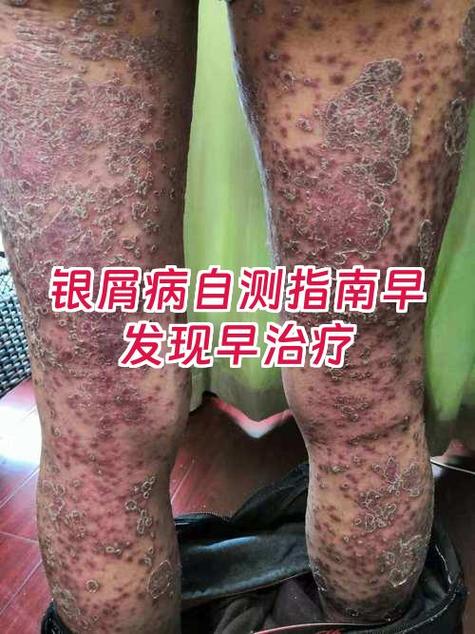 银屑病能治好吗
