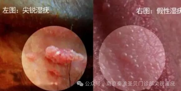 正常阴脣蝴蝶和尖锐的区别图标