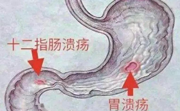 胃溃疡能自愈吗