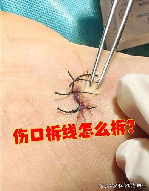 缝了三针可以自己拆线吗图标