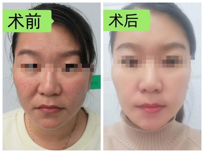 筋膜提拉术手术一般多少钱游戏截图
