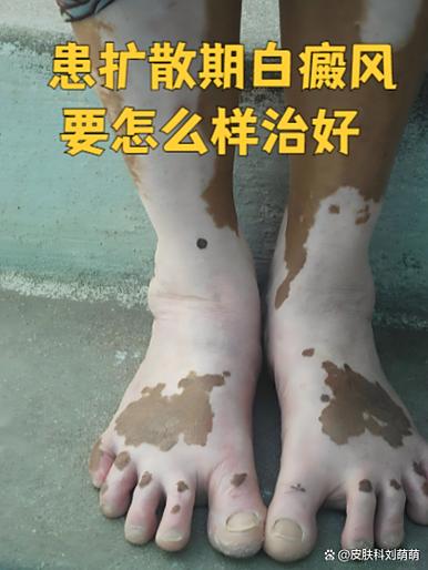 白癜风的治疗方法图标
