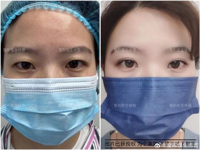 生态双眼皮是永久的吗缩略图
