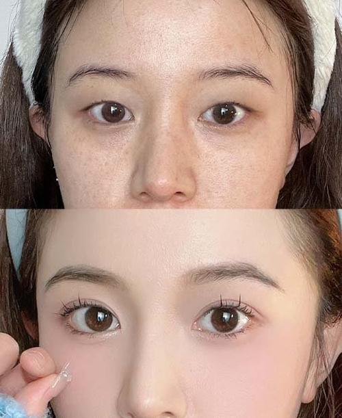 眼皮突然变成单眼皮还会变回来吗
