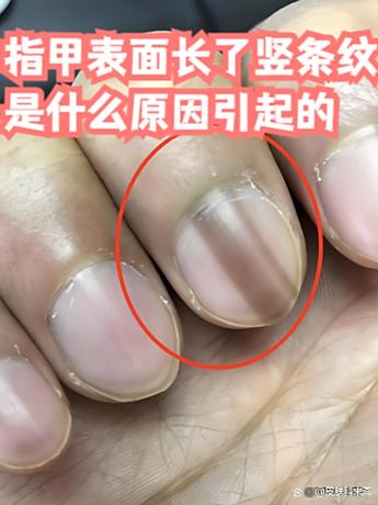 指甲黑纹警惕四种病缩略图