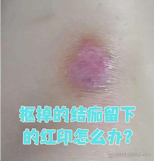 点斑后不小心扣掉了留下了个红印孑