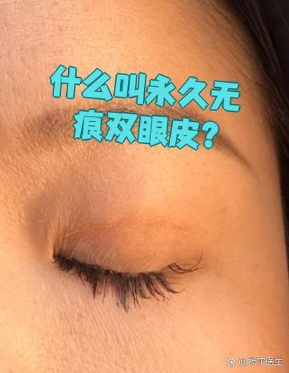 什么叫永久无痕双眼皮缩略图
