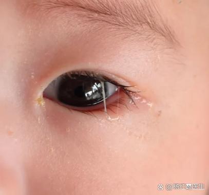 婴儿一边眼睛流眼水缩略图
