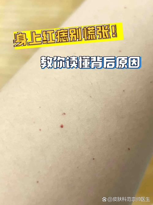 小红点不痛不痒原因