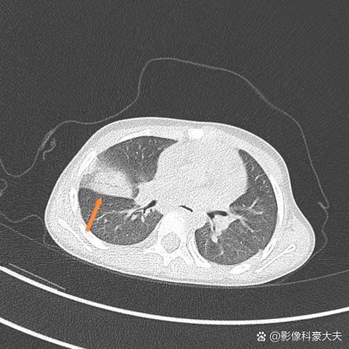 肺部有阴影有几种可能性