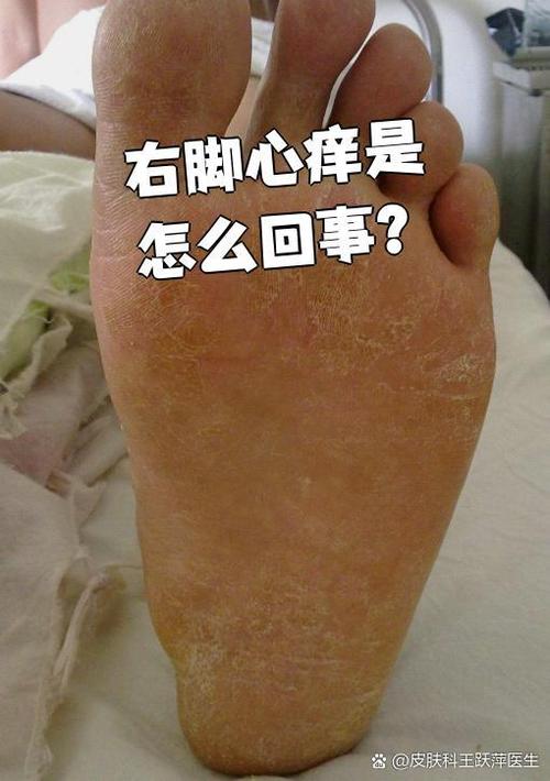 脚底钻心痒要警惕四种病缩略图