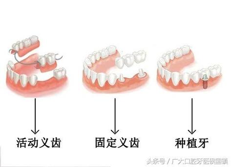 牙缺失最好的修复方式