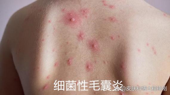 真菌感染与细菌感染的区别