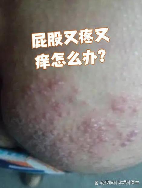 屁股疼痒缩略图
