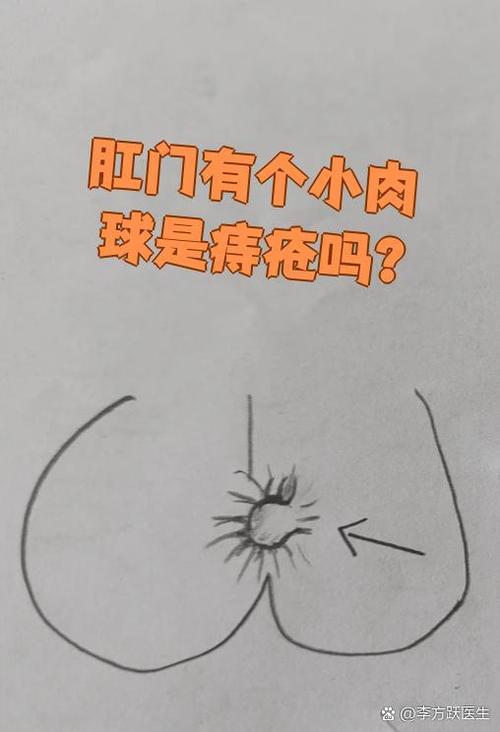 肛门口长个肉疙瘩是什么原因缩略图