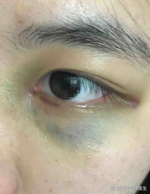 打架眼睛紫了怎么样消快