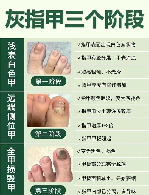 灰指甲怎么得的