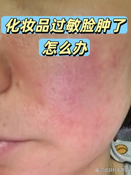 什么过敏会导致脸肿眼睛肿缩略图