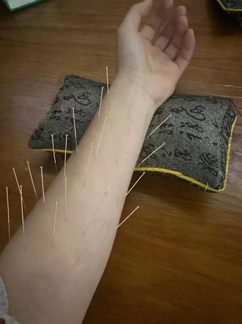针灸图片大全