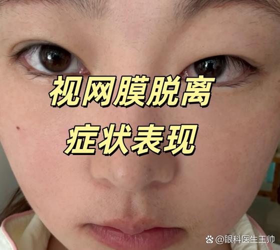 视网膜脱落眼睛的样子图标