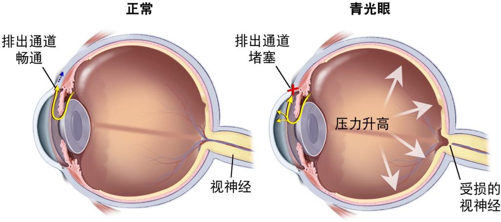 青光眼最佳治疗方法