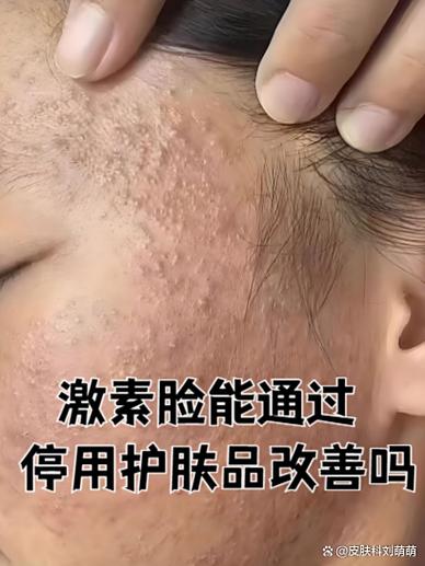脸部皮肤屏障受损一般要多长时间好
