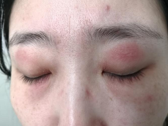 脸过敏眼睛肿是怎么回事缩略图