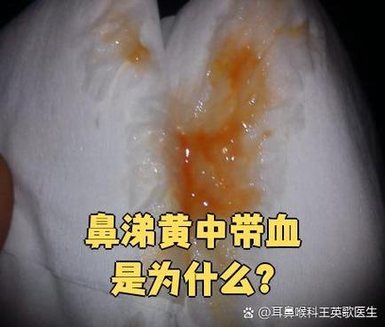 鼻子喷出浓黄的血鼻涕游戏截图
