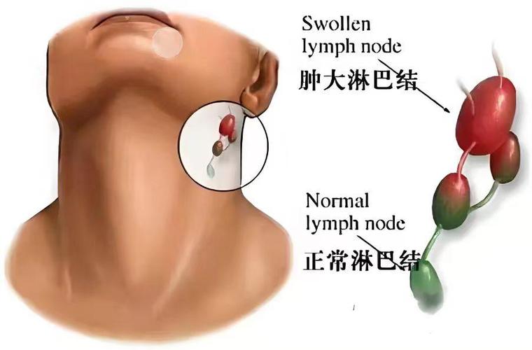 大家是怎么发现淋巴瘤的缩略图