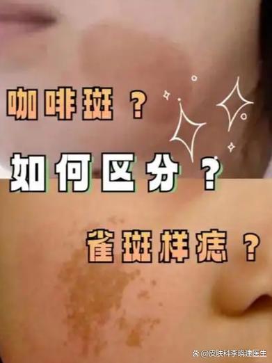 去雀斑的小妙招缩略图