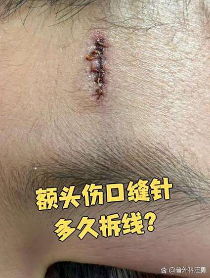 伤口缝合线会崩开吗