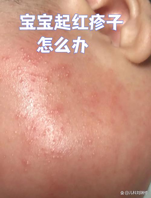 婴儿脸上长红疹子是怎么回事