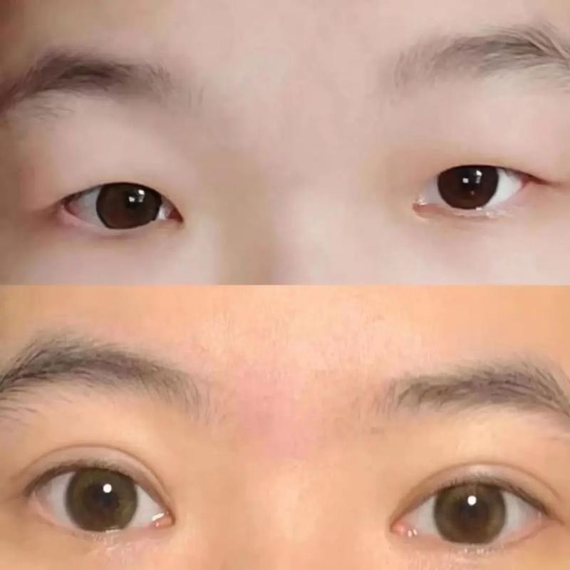一觉醒来单眼皮变双眼皮怎么恢复图标