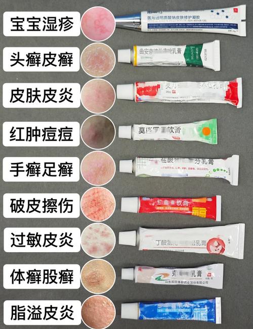 湿疹什么药最有效果